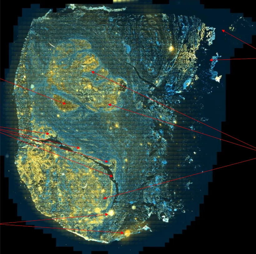 FLIM cancer classification in human lymph nodes